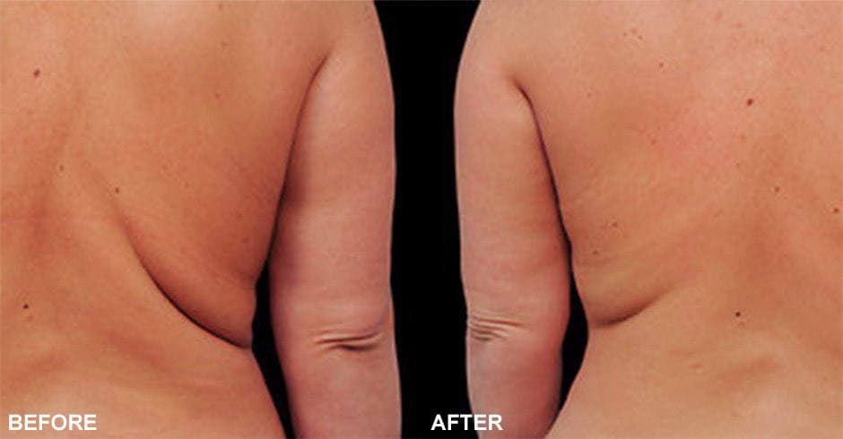 Coolsculpting before & after
