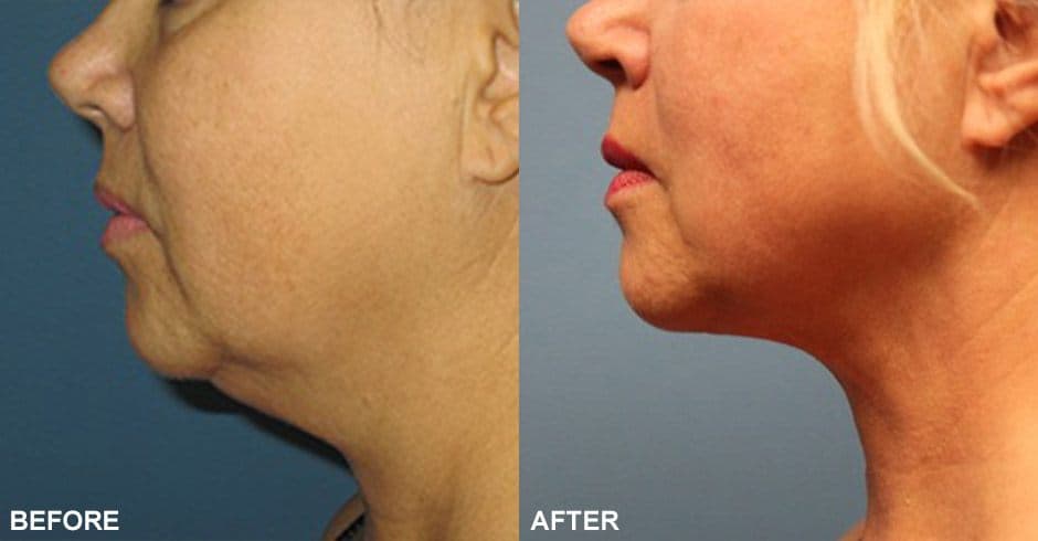 Smartlipo™ for the Neck Before & After