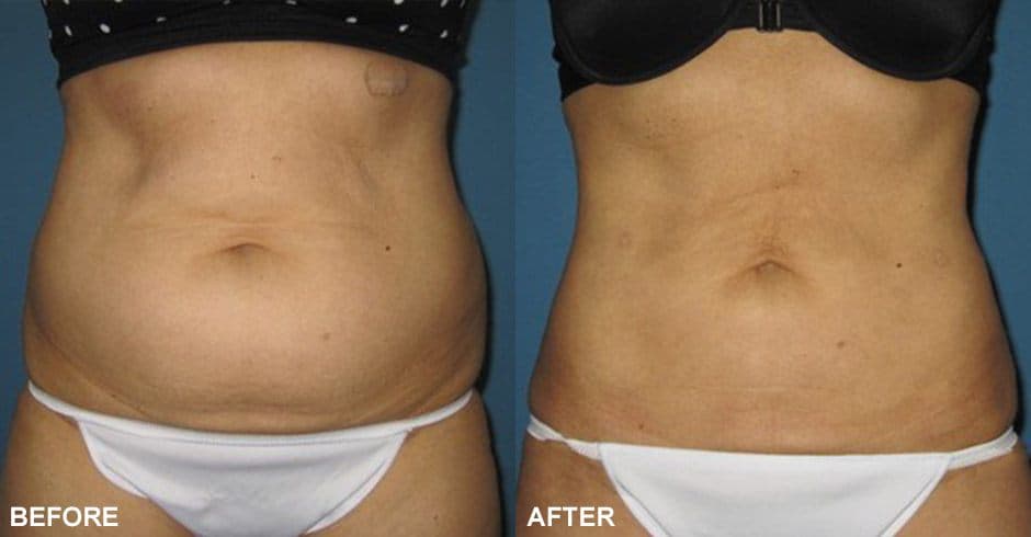 Smartlipo™ Before & after