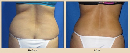 Before-and-after liposuction photos of a woman’s mid-back showing a reduction of fat from her bra strap area to her hips.