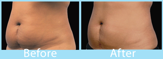 See CoolSculpting before and after images from Spokane.