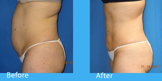 See before-and-after pictures of liposuction in Spokane.