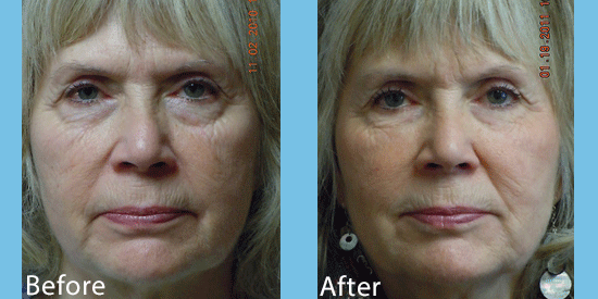 See before-and-after images from dermal filler patients from our cosmetic surgery practice in Spokane.