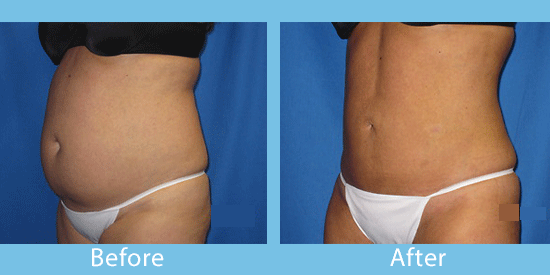 Smartlipo Coeur d'Alene and Spokane recovery before and after