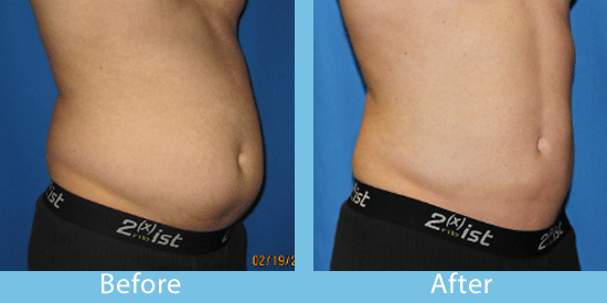 Learn about liposuction in Spokane.