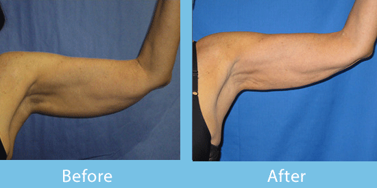 Before-and-after photos of a female patient showing visible reduction of fat under her arm after liposuction.