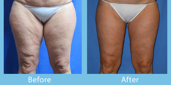 Learn about liposuction in Spokane.