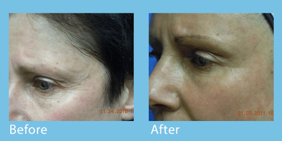 Close-ups of a female patient's left eye area before and after a CO2 laser skin treatment to reduce crow's feet wrinkles.