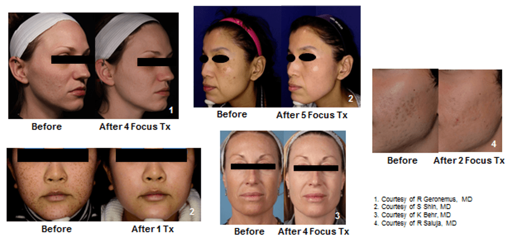 See before-and-after images of PicoFocus laser skin revitalization treatments.