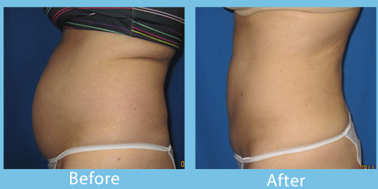 Side views of an Advanced Aesthetic patient's tummy before Smartlipo liposuction and a much flatter midsection after.