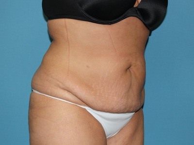 Our Patient After Liposuction Treatment Abdomen