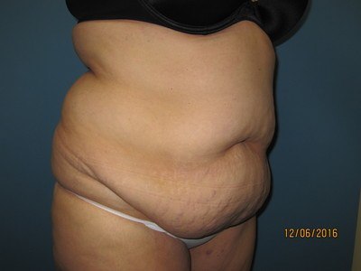 Our Patient Before Liposuction Treatment Abdomen