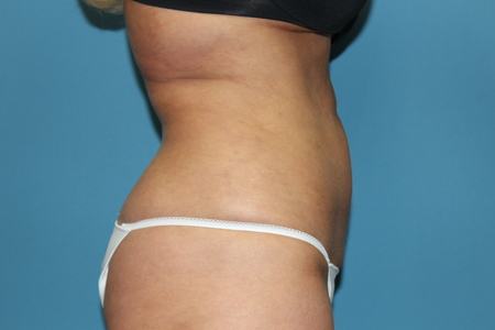 Side View Tummy After Liposuction Treatment