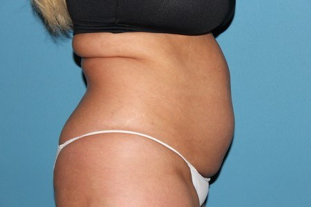 Side View Tummy Before Liposuction Treatment