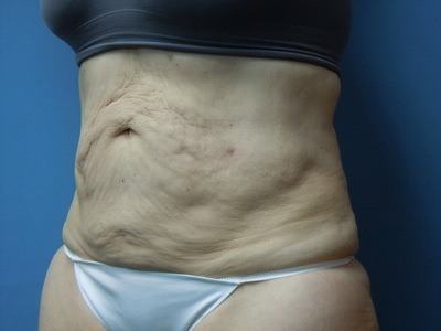 Tummy After Liposuction Treatment