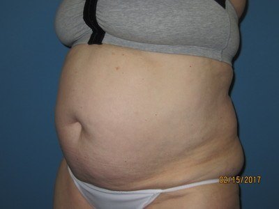 Tummy Before Liposuction Treatment