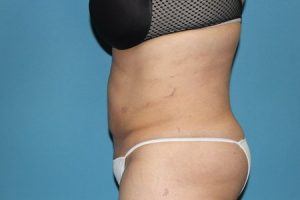 Liposuction Patient After Treatment Left View Tummy