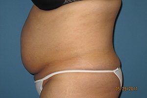 Liposuction Patient Before Treatment Left View Tummy