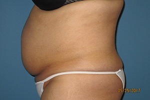Liposuction Patient Before Treatment Left View Tummy
