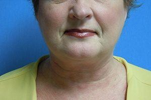 Patient After Liposuction Treatment Chin
