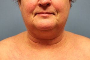 Patient Before Liposuction Treatment Chin