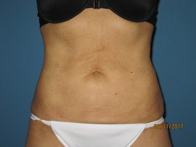 Patient After Liposuction Treatment Stomach Front