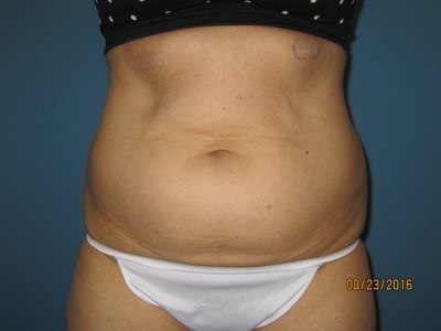 Patient Before Liposuction Treatment Stomach Front