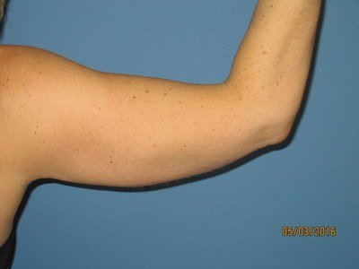 Our Patient's Arms After Liposuction Treatment