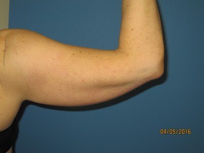 Our Patient's Arms Before Liposuction Treatment