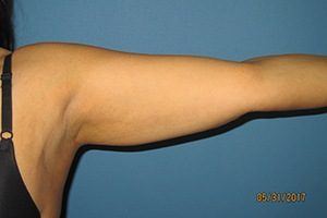 Arm After Liposuction Treatment