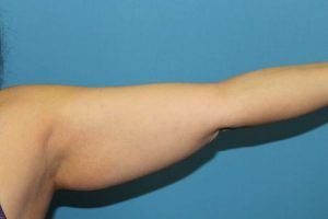 Arm Before Liposuction Treatment