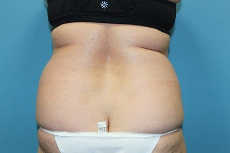 Rear View Before Liposuction Treatment