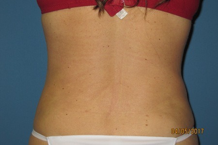 After Liposuction Treatment Back and Buttocks