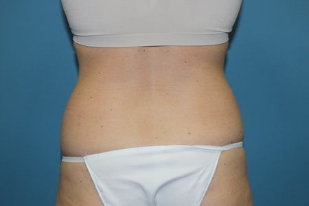 Before Liposuction Treatment Back and Buttocks