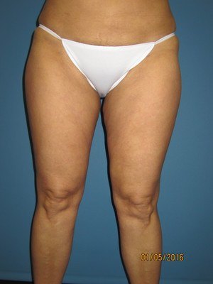 Legs and Tummy After Liposuction Treatment