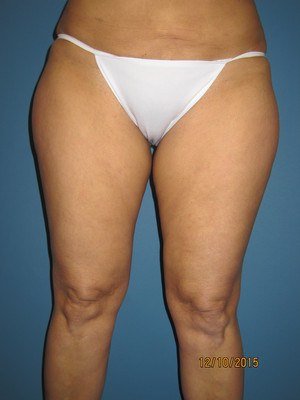 Legs and Tummy Before Liposuction Treatment