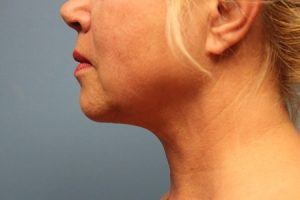 Side View Chin After Liposuction Treatment