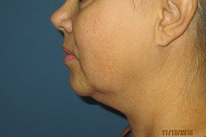 Side View Chin Before Liposuction Treatment