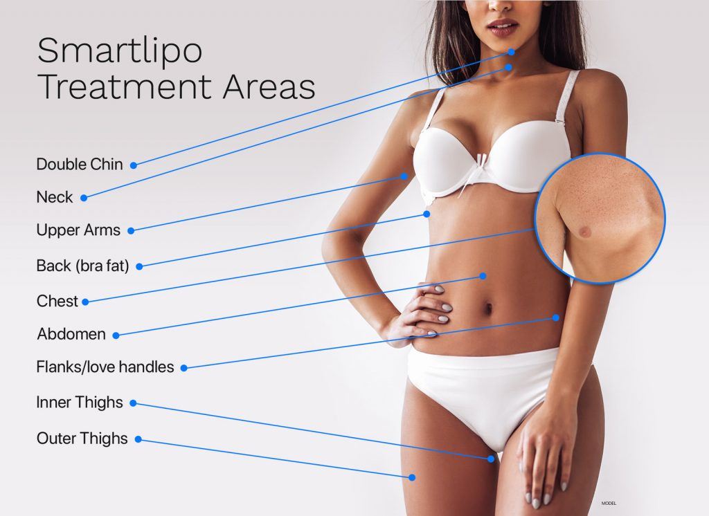 Smartlipo treatment areas for double chin, neck, upper arms, back, chest, abdomen, flanks, and thighs