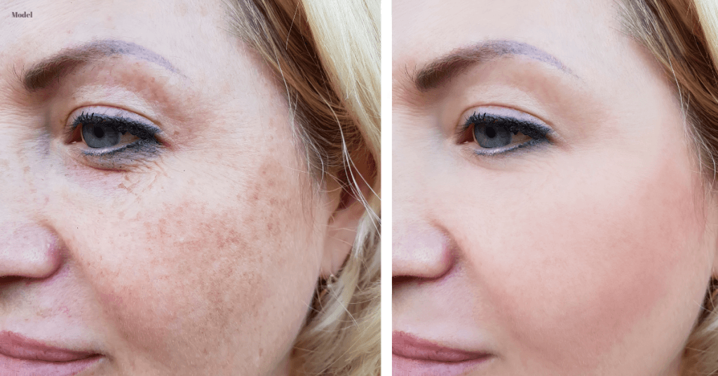 Patient (model) laser treatment results to help her hyperpigmentation