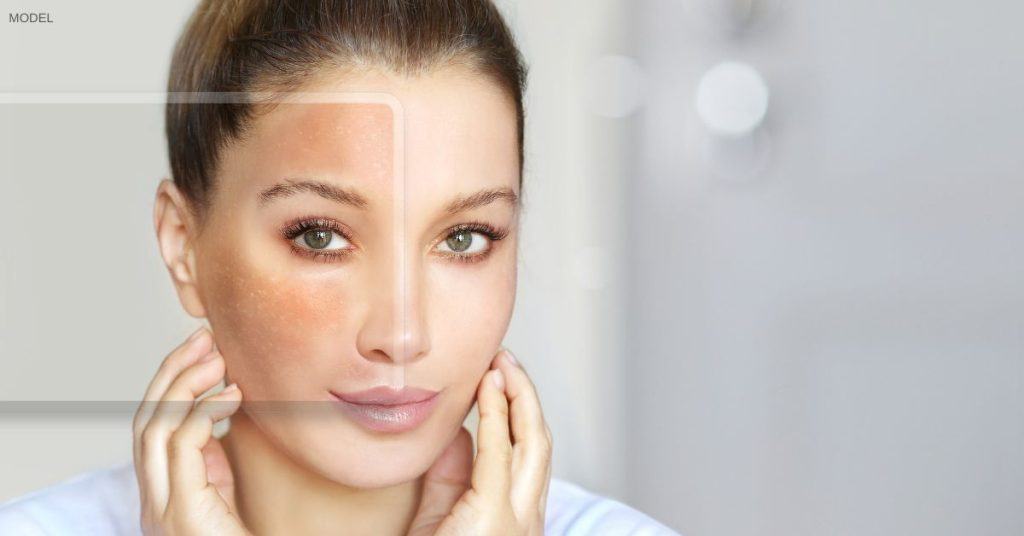 Woman (model) showing skin damage on part of her face with the rest of her face clear of damage to highlight the differences that can be brought about by treatments such as laser skin resurfacing.