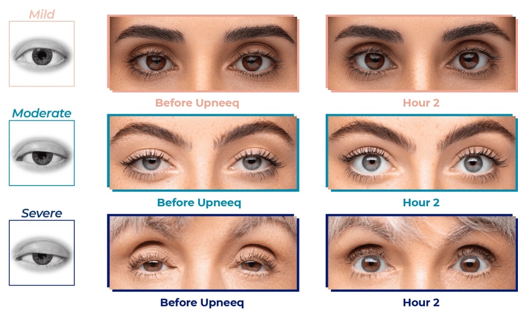 Before and after UPNEEQ prescription eye drops for non surgical eye lift for mild, moderate, and severe acquired eyelid ptosis.