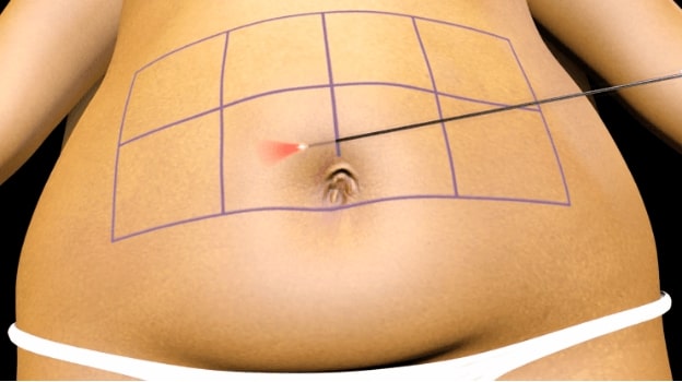 Patient's abdomen shown with a grid as well as a micro-cannula to illustrate the process of Smartlipo.