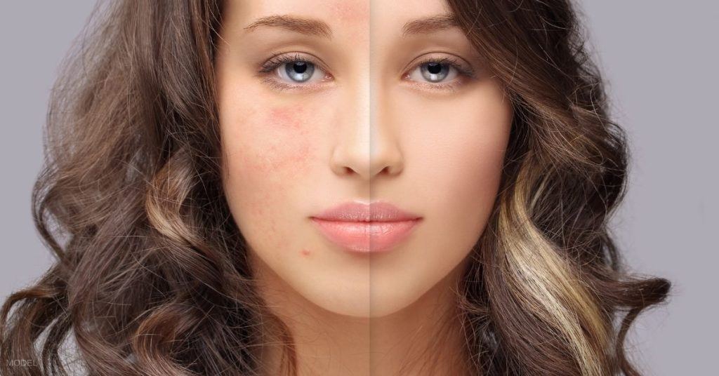 Woman (model) with acne scars on one half of her face, and clear skin on the other half.