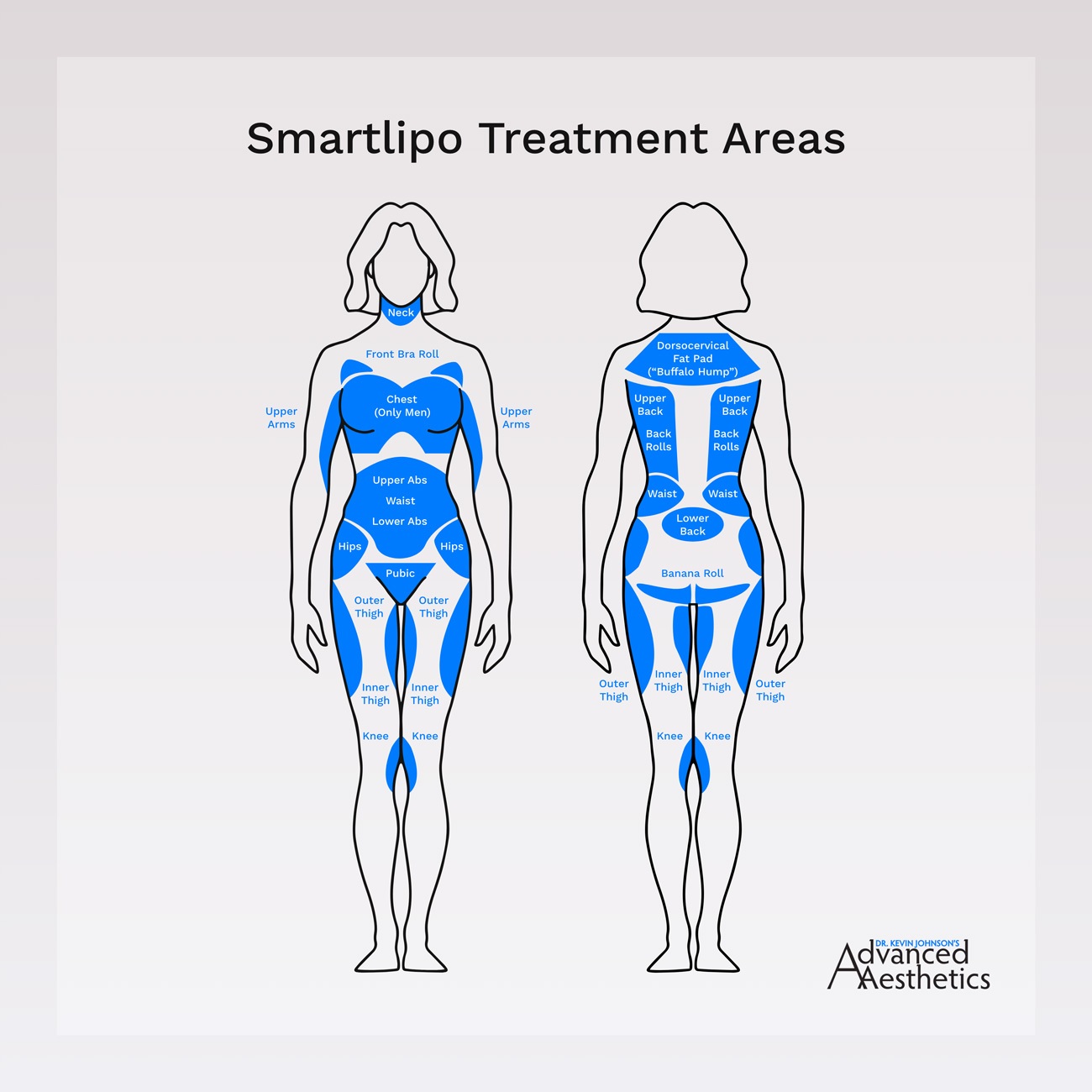 Smartlipo treatment areas for neck, upper arms, back, chest, abdomen, flanks, thighs, knees