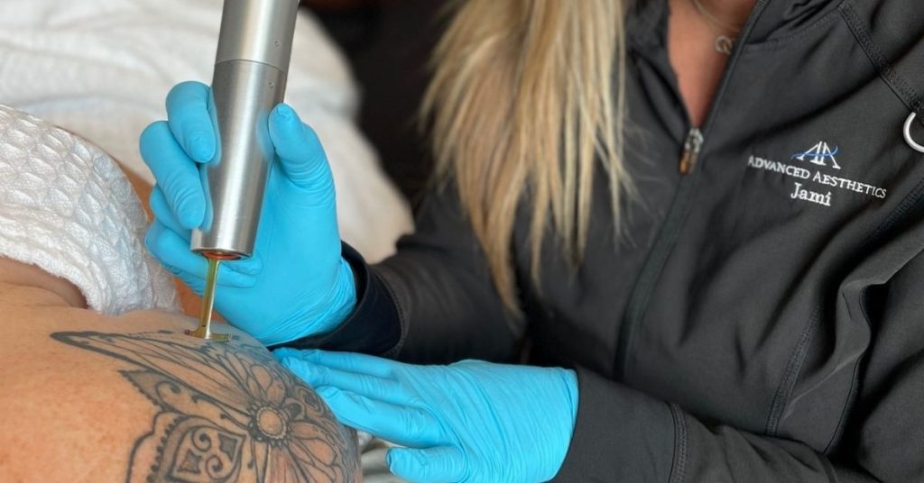Real patient laser tattoo removal treatment performed by Jami at Advanced Aesthetics in CDA
