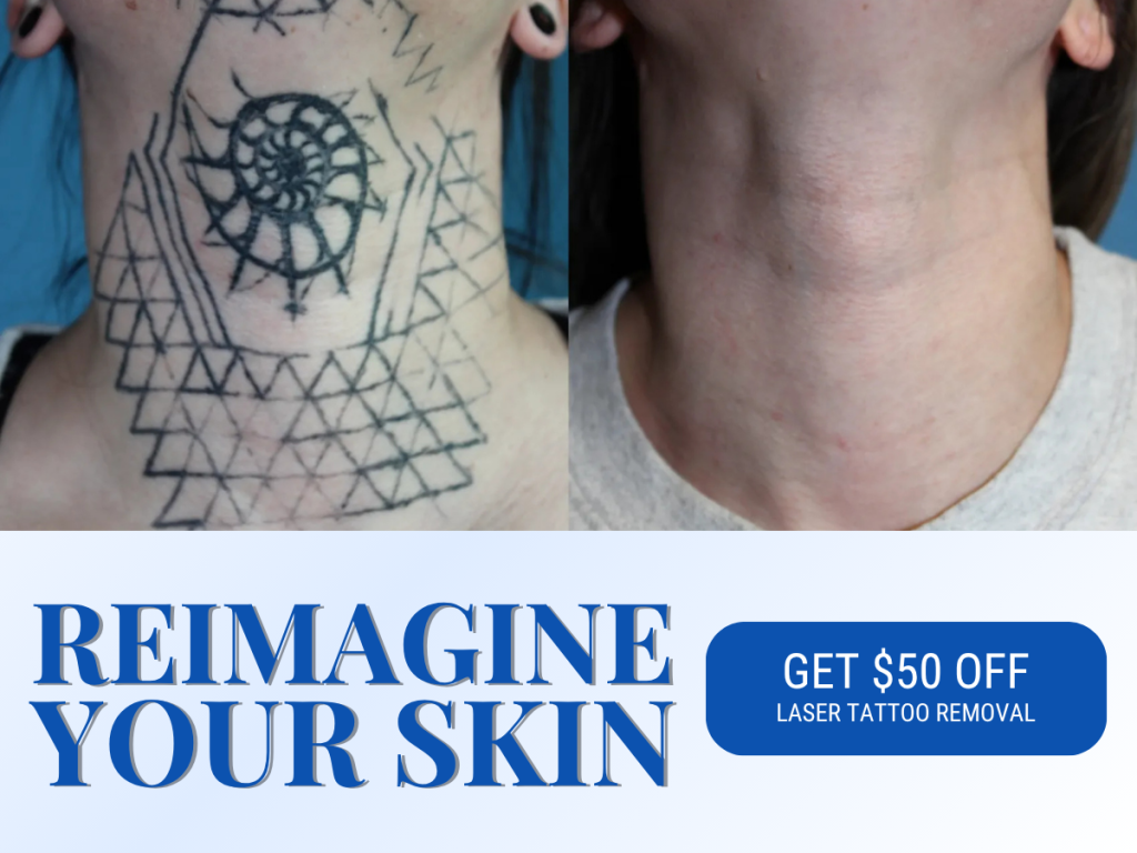 Real patient before & after tattoo removal photo with a headline that reads reimagine your skin and $50 off laser tattoo removal offer.