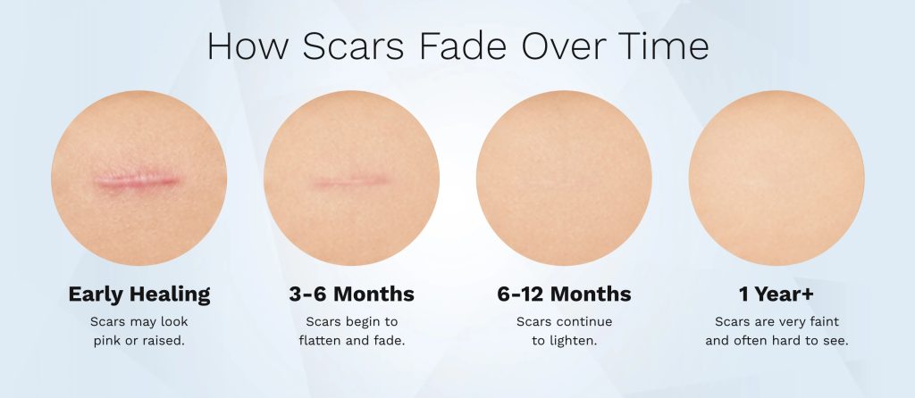 Liposuction infographic showing the stages of scar fading over time.
