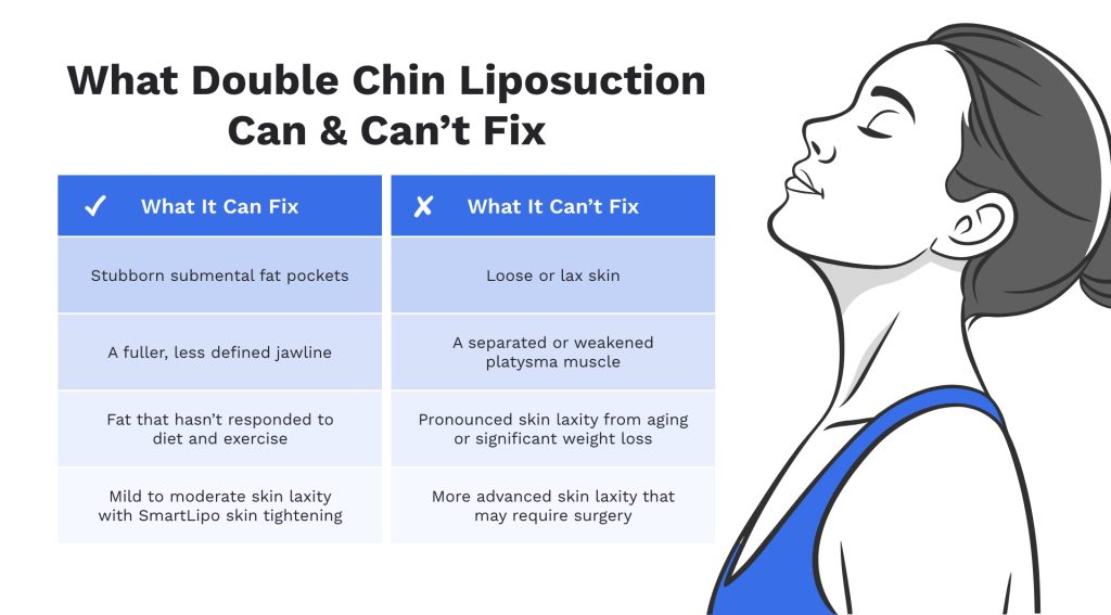Graphic titled “What Double Chin Liposuction Can & Can’t Fix,” comparing concerns the procedure may address.