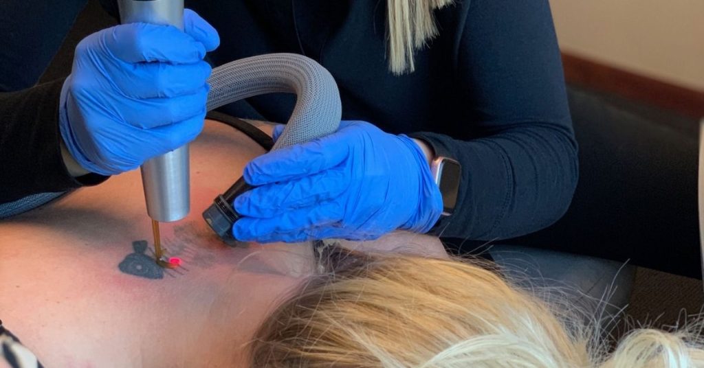 In-office Laser Tattoo Removal session